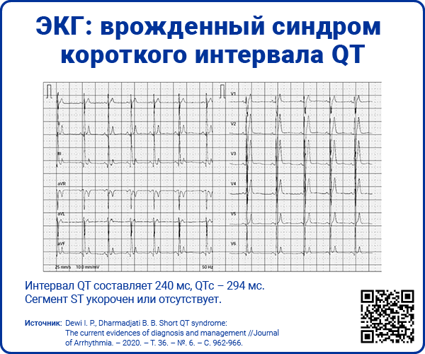 ЭКГ врожденный синдром короткого интервала QT